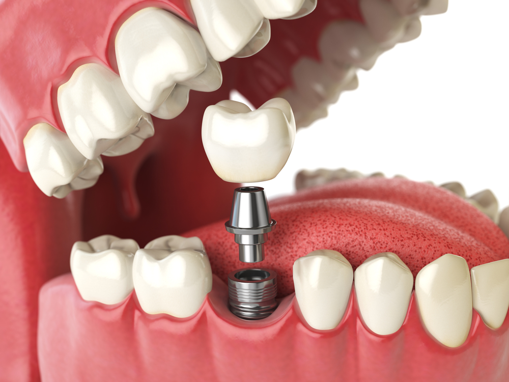example of dental implant